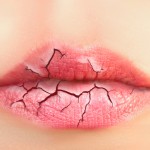 Remedies for Dry Lips
