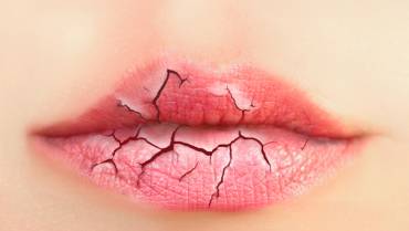 Remedies for Dry Lips