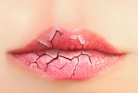Remedies for Dry Lips