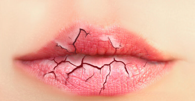 Remedies for Dry Lips