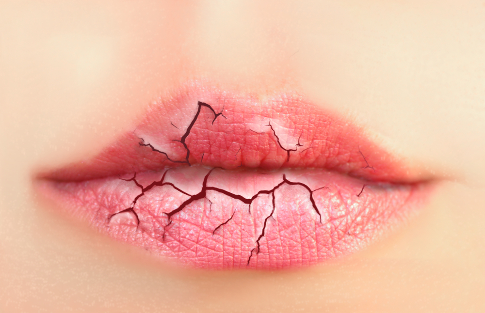 Remedies for Dry Lips