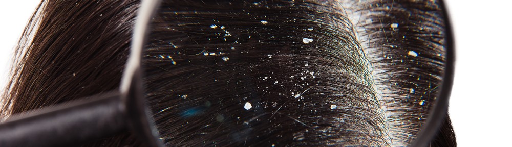 Myths about dandruff