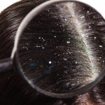 Myths about dandruff