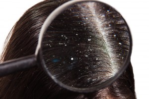 Myths about dandruff