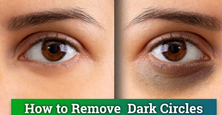 how to remove dark circles under eyes