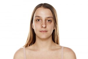 reduce dark circles