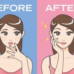 Remedies for acne and acne scars