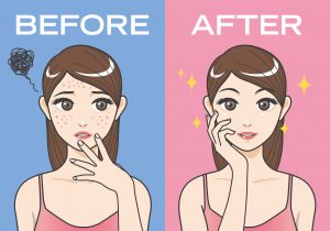 Remedies for acne