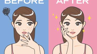 Remedies for acne and acne scars