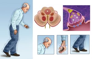 Parkinson's Disease Treatments