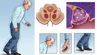 Parkinson’s Disease Treatments & Drugs