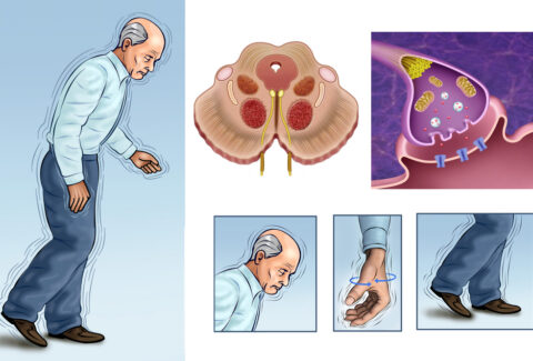 Parkinson's Disease Treatments