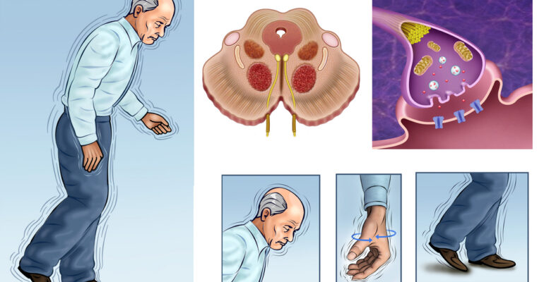 Parkinson's Disease Treatments