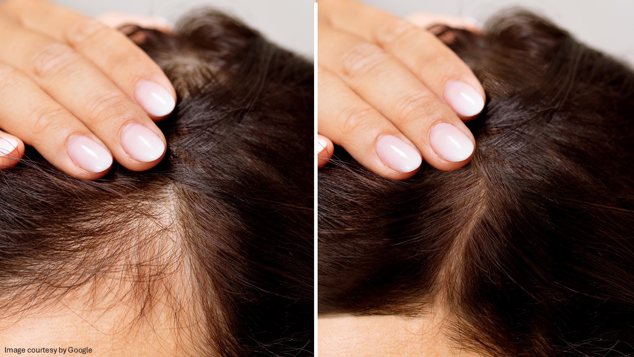 female hair loss - ADC
