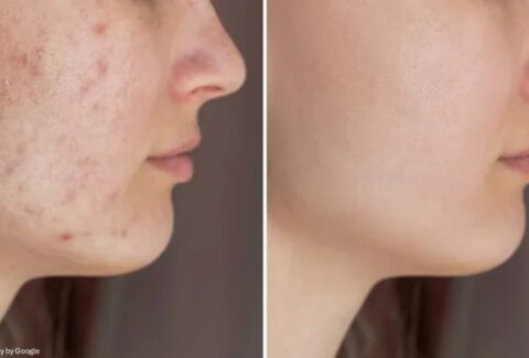 Acne Treatment​ - ADC