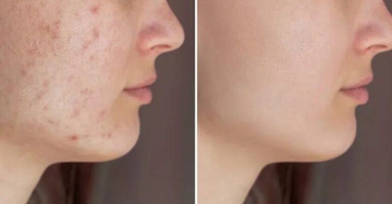 Acne Treatment​ - ADC
