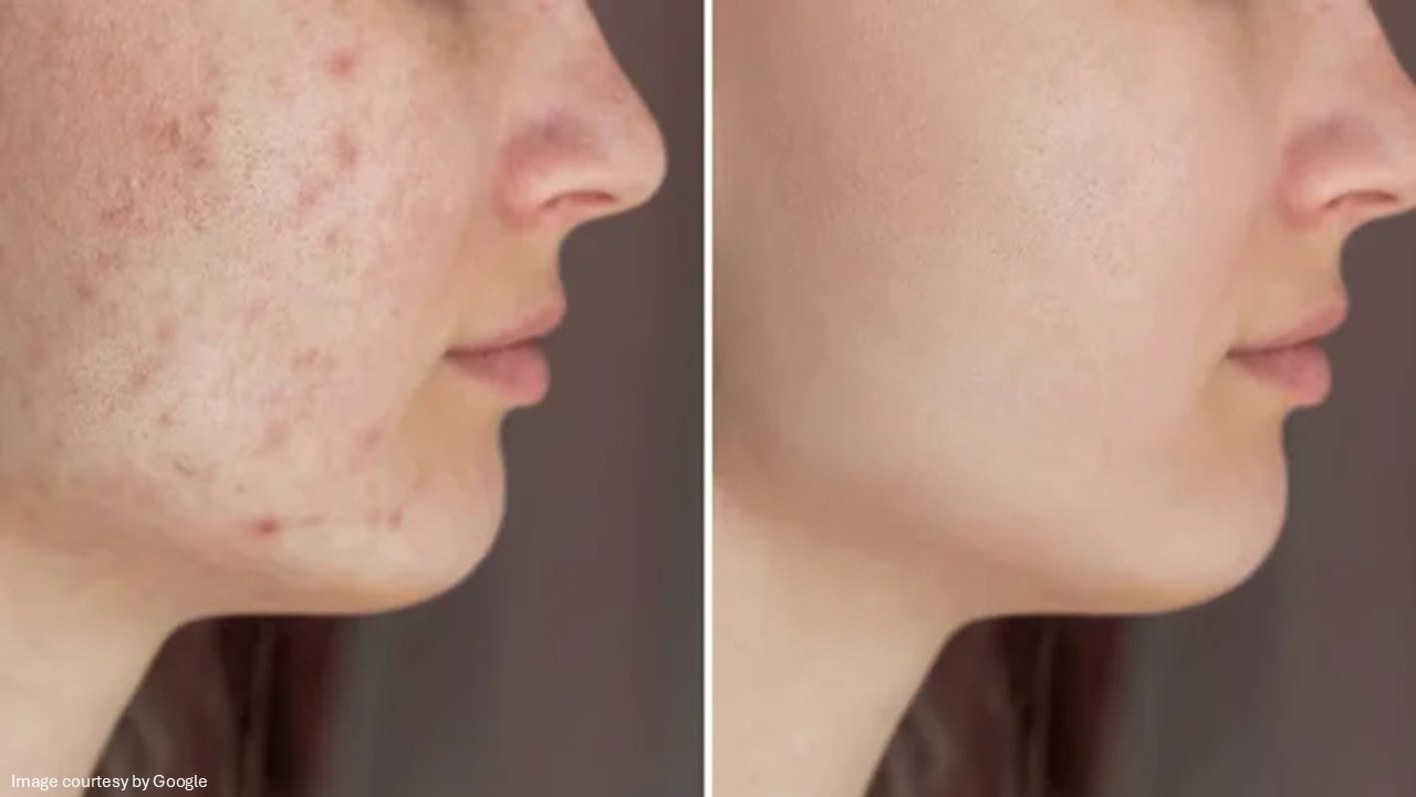 Acne Treatment​ - ADC