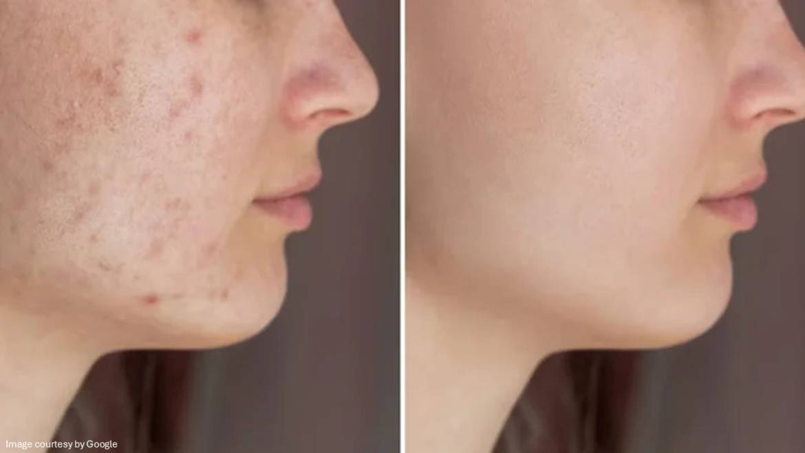 How to Remove & Clear up Acne Overnight