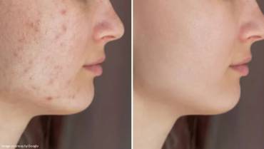 How to Remove & Clear up Acne Overnight