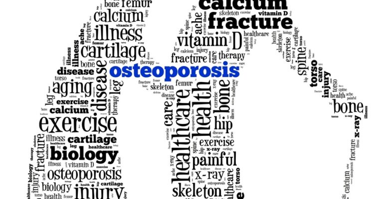 How to Prevent Osteoporosis and Osteoporosis Causes