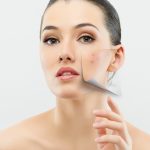 How to Remove & Clear up Acne Overnight