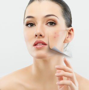 How to Remove & Clear up Acne Overnight