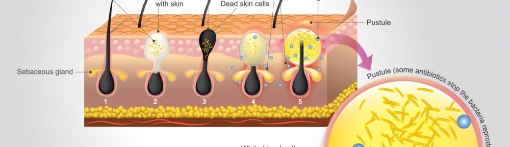 How to treat & manage acne vulgaris