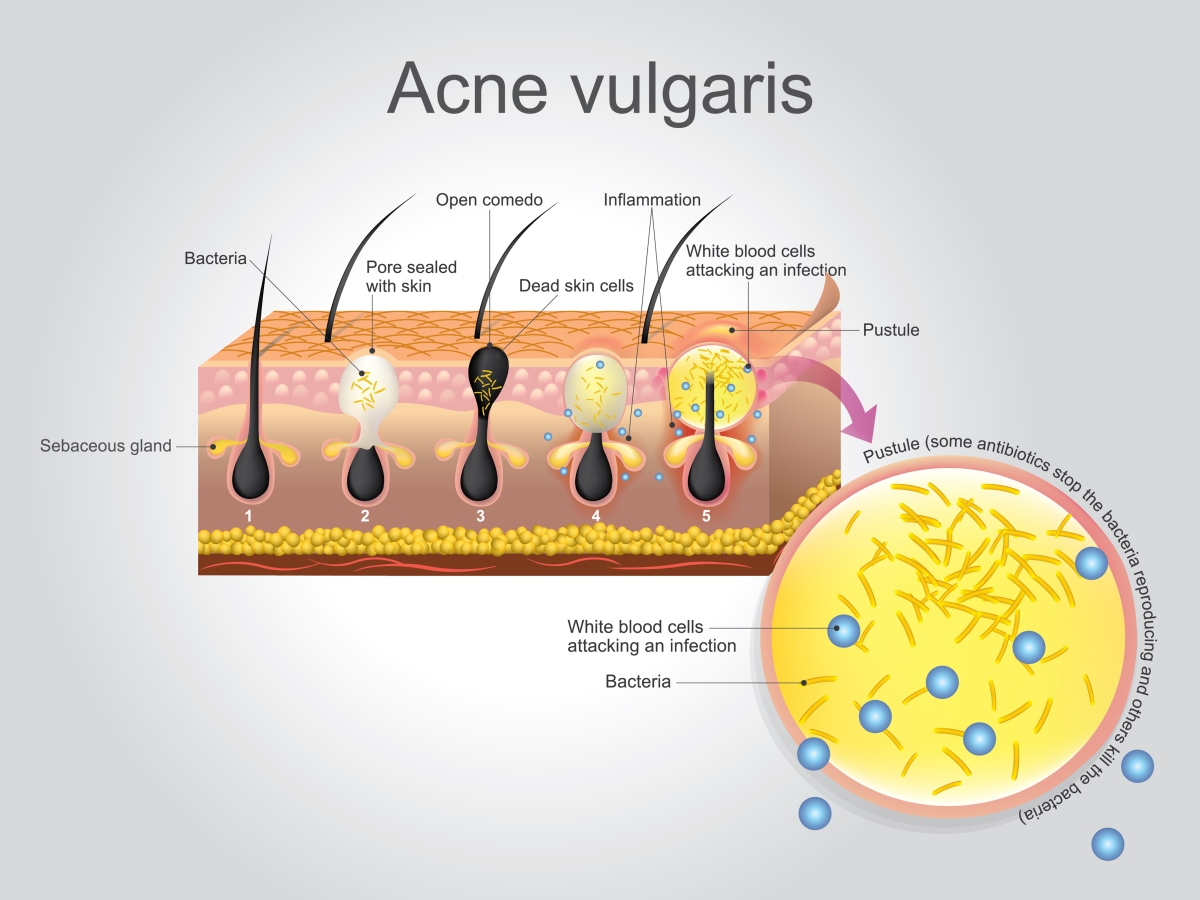 How to treat & manage acne vulgaris 