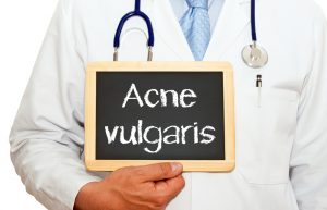 How to treat & manage acne vulgaris
