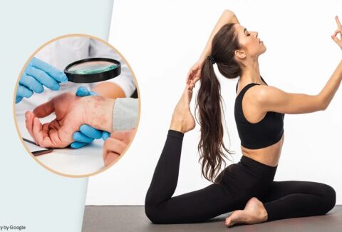 psoriatic arthritis and yoga - ADC