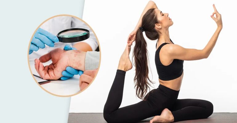 psoriatic arthritis and yoga - ADC