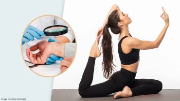 Yoga Can Help in Psoriatic Arthritis Pain
