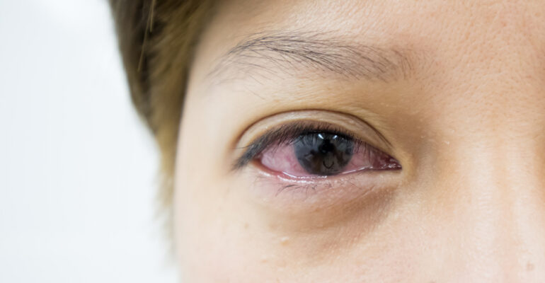 Eye Symptoms and What They Could Cause