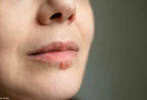 genital herpes women