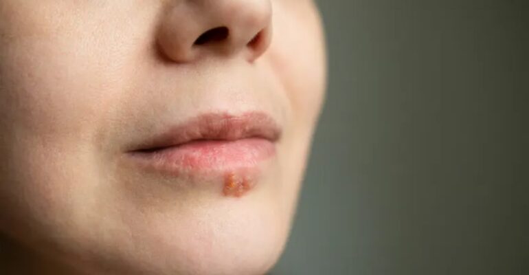 genital herpes women