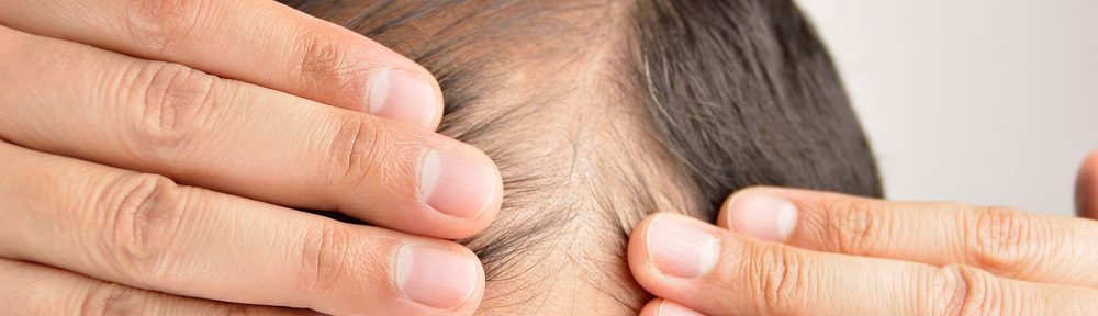 Promote Hair Growth and Prevent Hair Loss