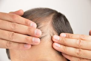 Promote Hair Growth and Prevent Hair Loss