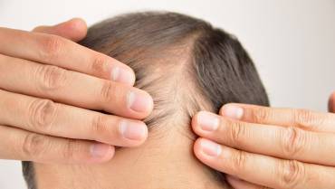 Promote Hair Growth and Prevent Hair Loss