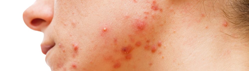 Top 5 Reasons Why Your Acne Keeps Coming Back!