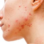 Top 5 Reasons Why Your Acne Keeps Coming Back!