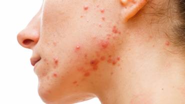 Top 5 Reasons Why Your Acne Keeps Coming Back!