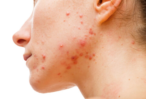 Top 5 Reasons Why Your Acne Keeps Coming Back!