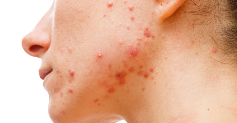 Top 5 Reasons Why Your Acne Keeps Coming Back!