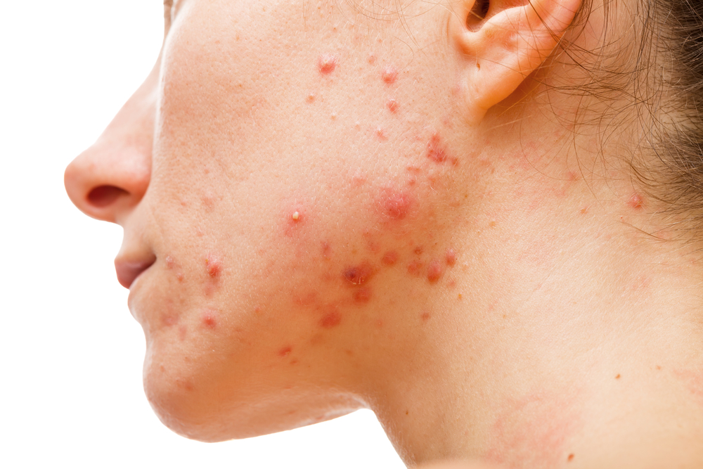 Top 5 Reasons Why Your Acne Keeps Coming Back!