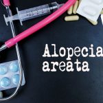 What is Alopecia Areata? Can this type of Hair Loss be treated?
