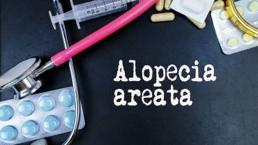 What is Alopecia Areata? Can this type of Hair Loss be treated?