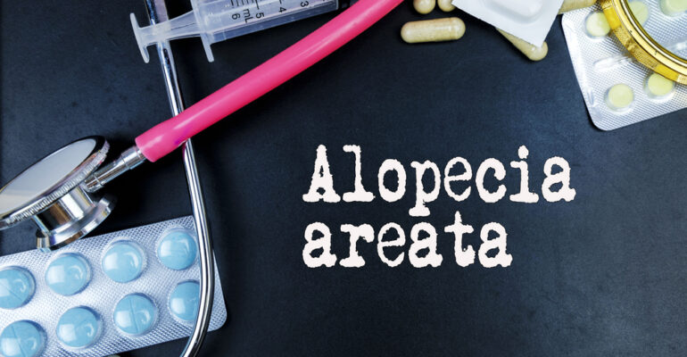 What is Alopecia Areata? Can this type of Hair Loss be treated?