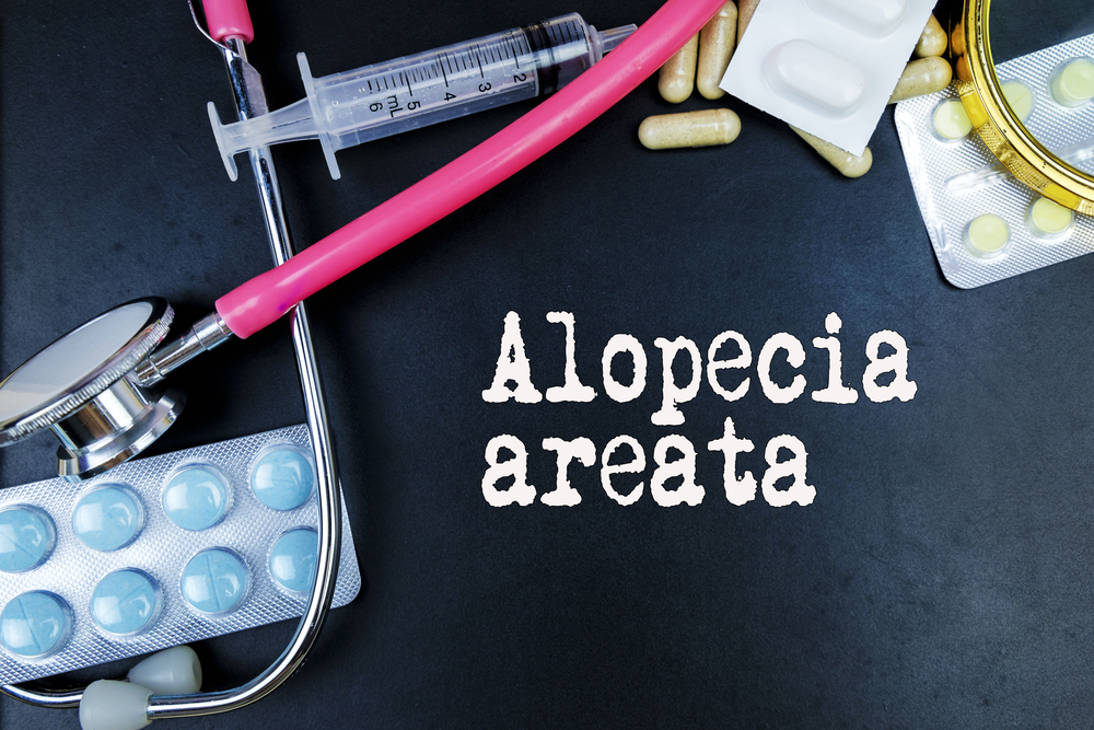 What is Alopecia Areata? Can this type of Hair Loss be treated?