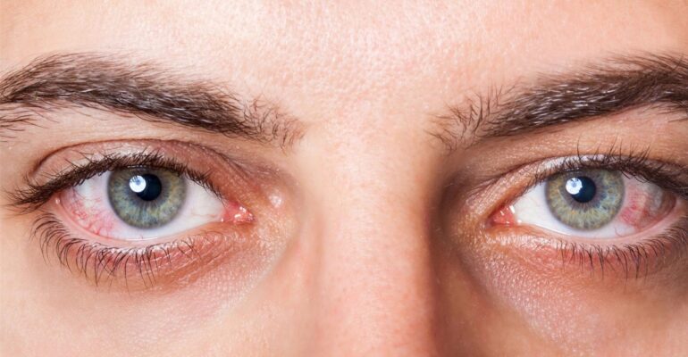 dry eye symptoms - All Day Chemist