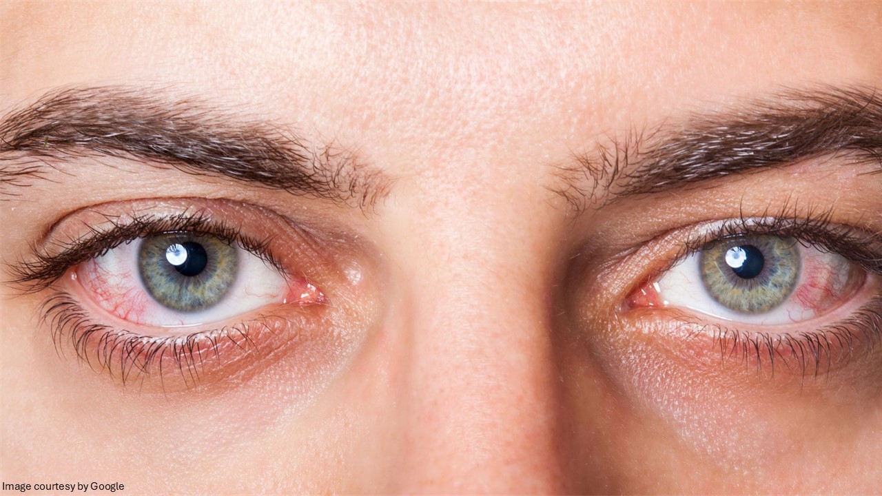 dry eye symptoms - All Day Chemist